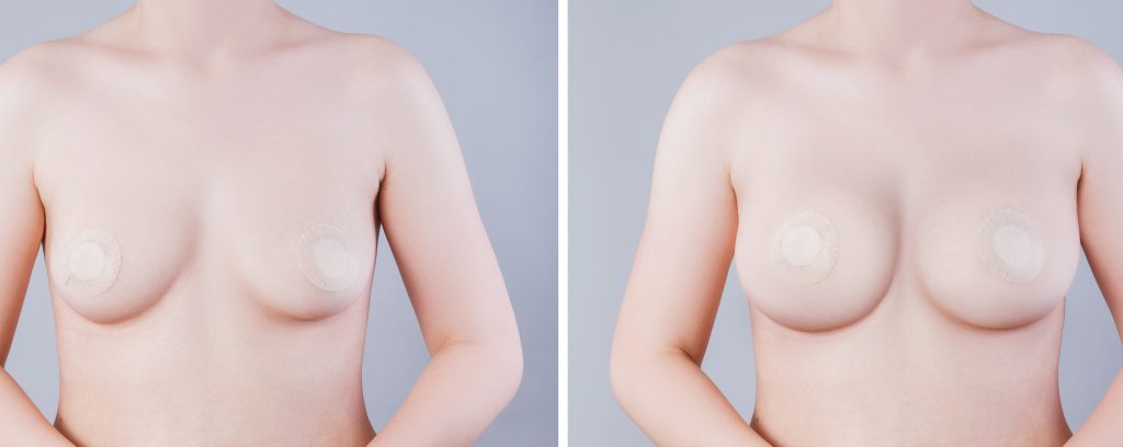 Woman,Before,And,After,Breast,Size,Correction,On,Color,Background.